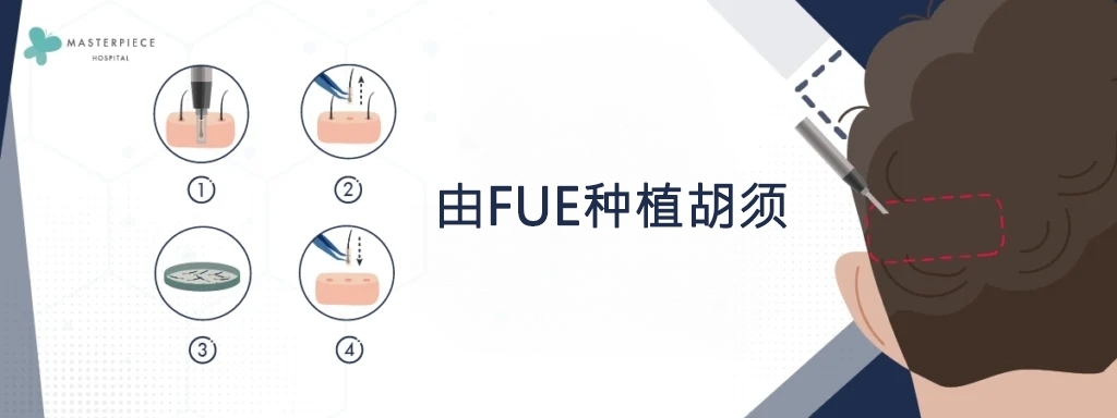 由FUE种植胡须