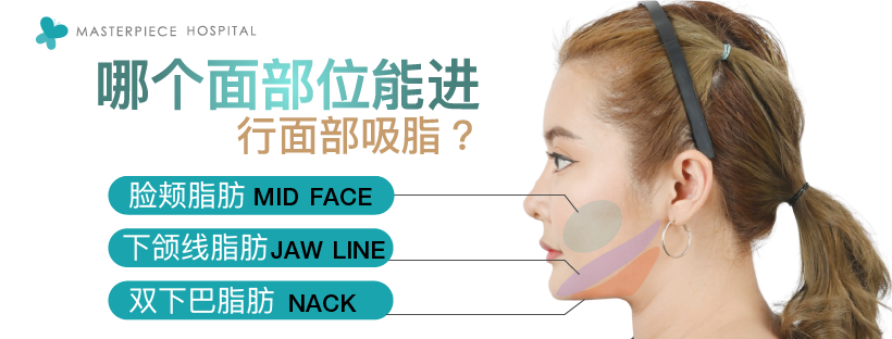 哪个面部位能进行面部吸脂？